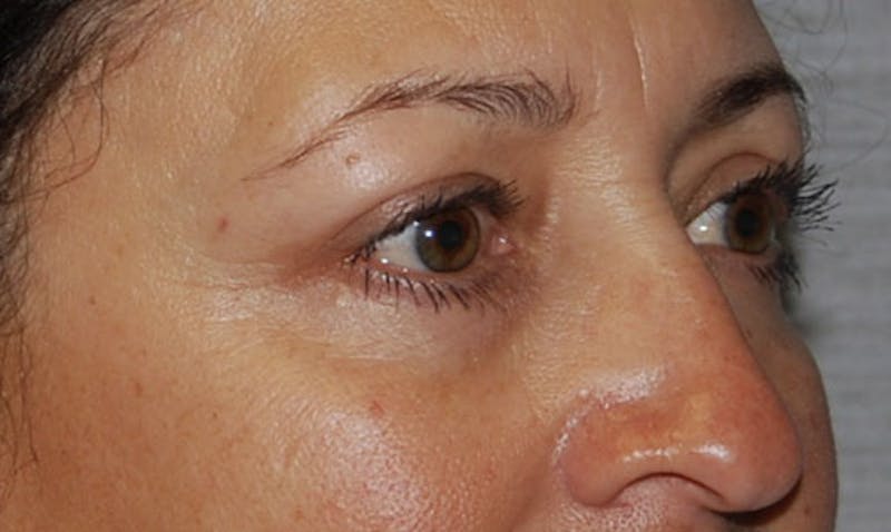 Eyelid Surgery Before & After Gallery - Patient 133023904 - Image 4