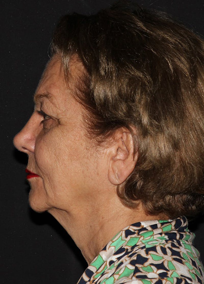 Facelift & Necklift Before & After Gallery - Patient 133023908 - Image 3
