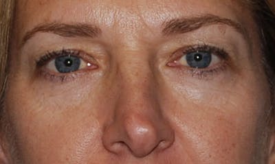 Eyelid Surgery Before & After Gallery - Patient 133023906 - Image 1