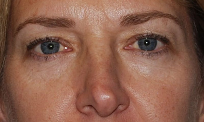 Eyelid Surgery Before & After Gallery - Patient 133023906 - Image 1