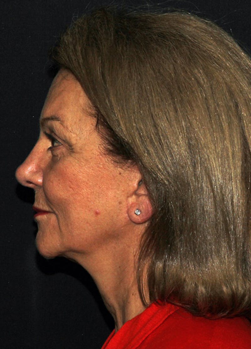 Facelift & Necklift Before & After Gallery - Patient 133023908 - Image 4