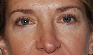 Eyelid Surgery Before & After Gallery - Patient 133023906 - Image 2
