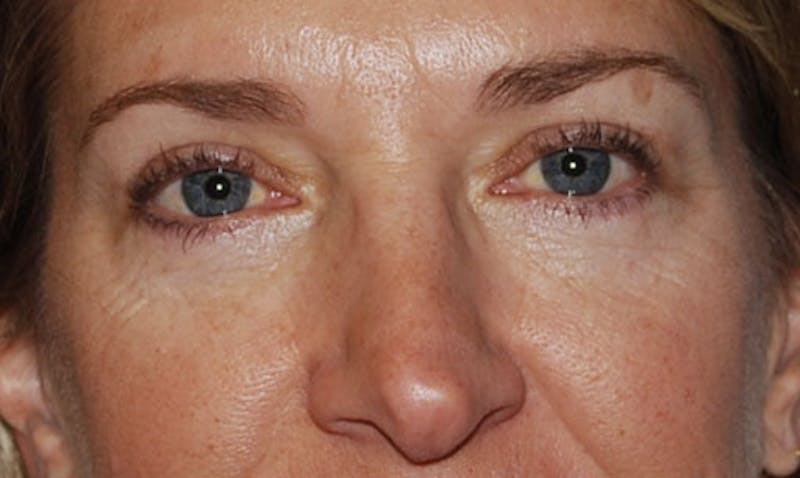 Eyelid Surgery Before & After Gallery - Patient 133023906 - Image 2
