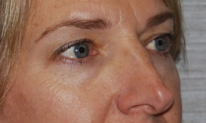 Eyelid Surgery Before & After Gallery - Patient 133023906 - Image 3