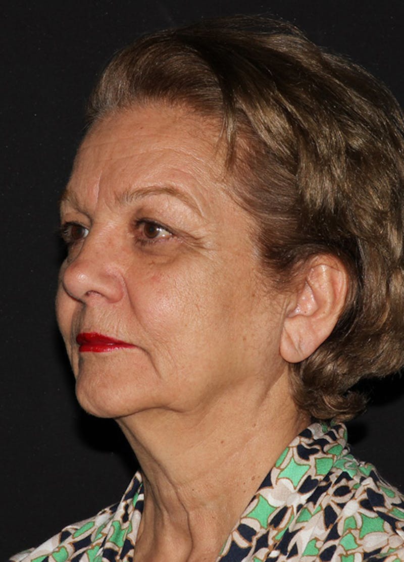 Facelift & Necklift Before & After Gallery - Patient 133023908 - Image 5