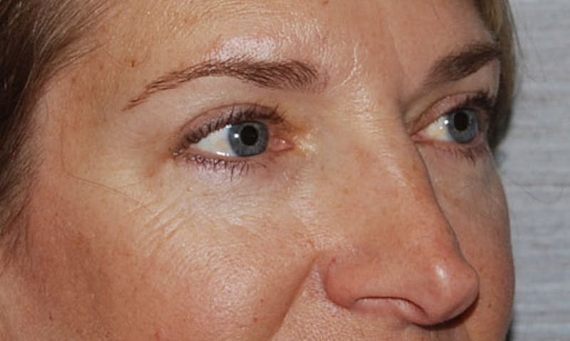 Eyelid Surgery Before & After Gallery - Patient 133023906 - Image 4