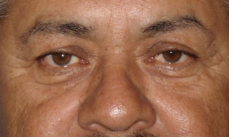Eyelid Surgery Before & After Gallery - Patient 133023909 - Image 1