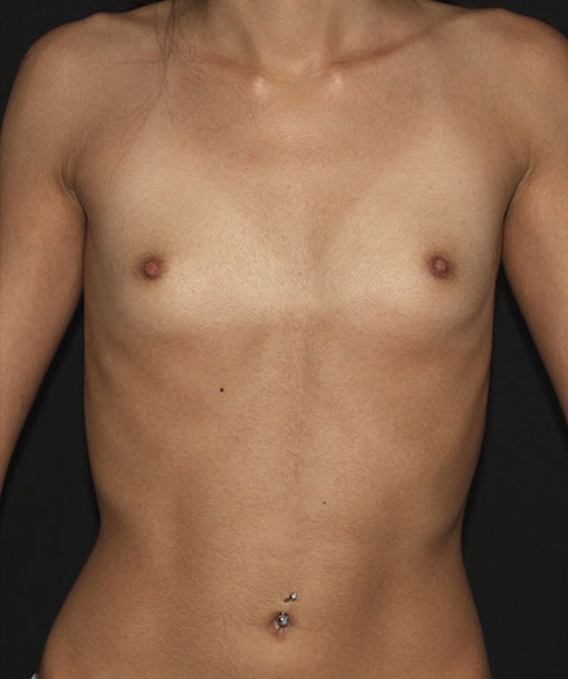 Breast Augmentation Before & After Gallery - Patient 133023916 - Image 1
