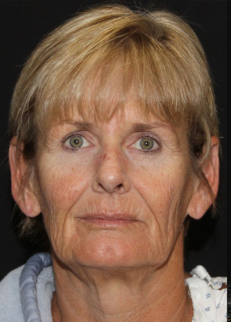 Facelift & Necklift Before & After Gallery - Patient 133023913 - Image 1