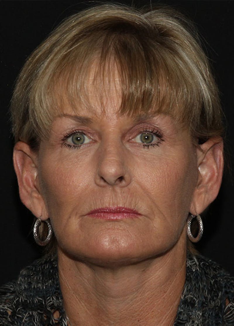 Facelift & Necklift Before & After Gallery - Patient 133023913 - Image 2