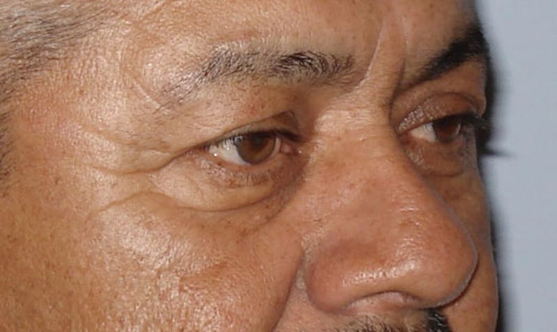 Eyelid Surgery Before & After Gallery - Patient 133023909 - Image 3