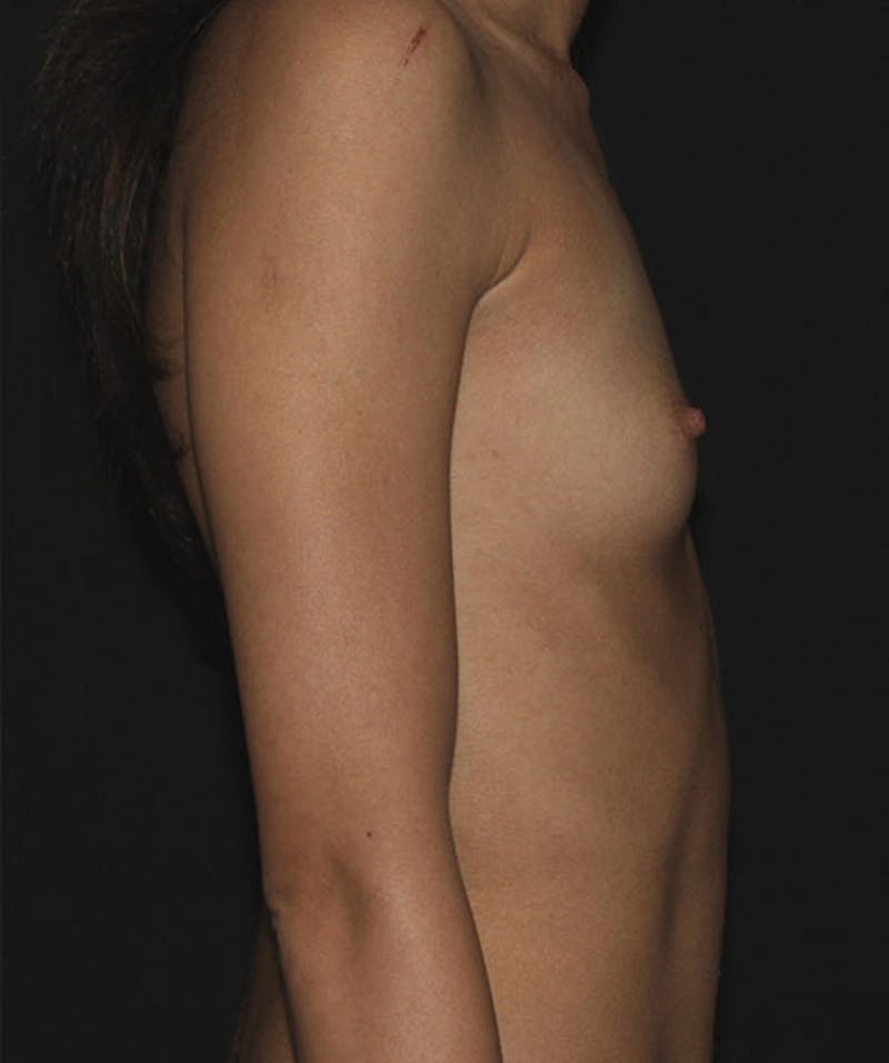 Breast Augmentation Before & After Gallery - Patient 133023916 - Image 3