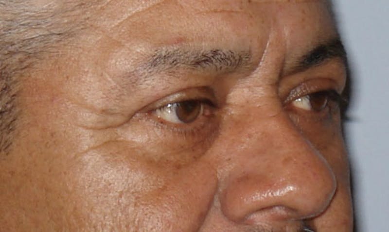 Eyelid Surgery Before & After Gallery - Patient 133023909 - Image 4
