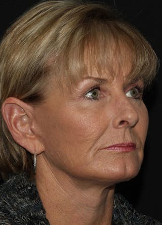 Facelift & Necklift Before & After Gallery - Patient 133023913 - Image 4