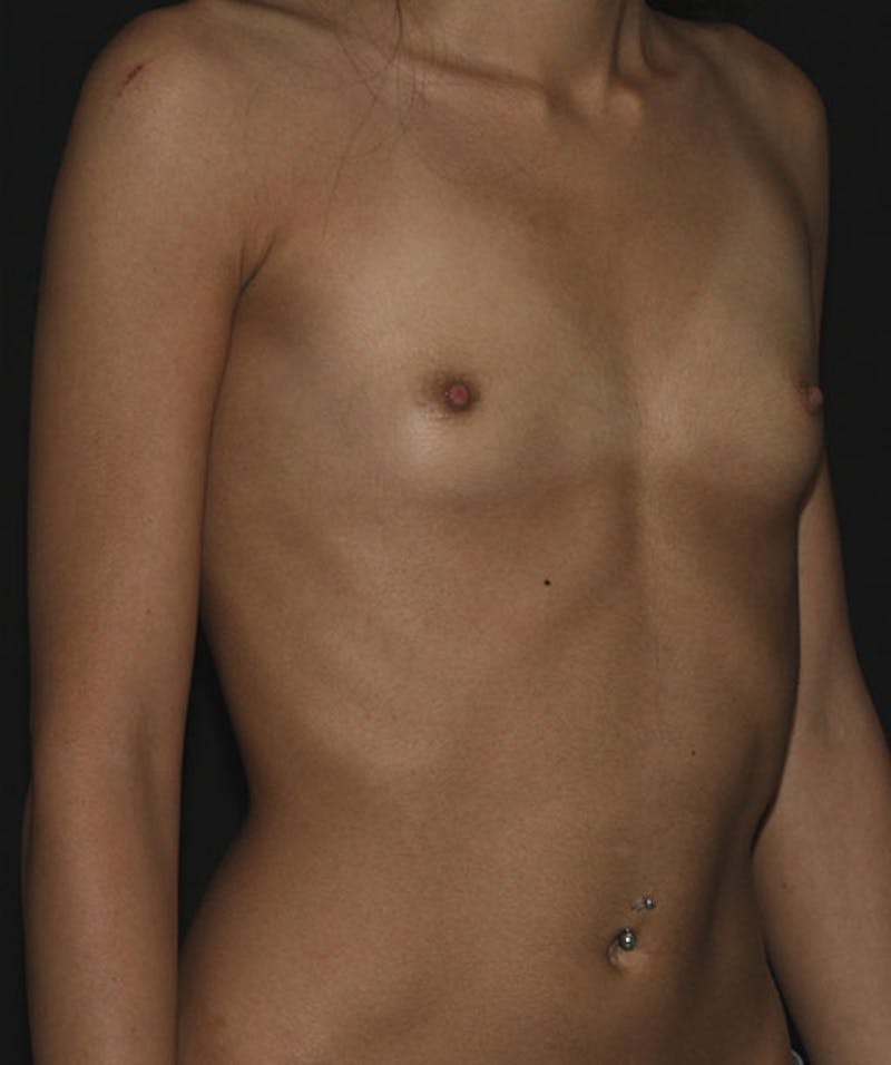 Breast Augmentation Before & After Gallery - Patient 133023916 - Image 5