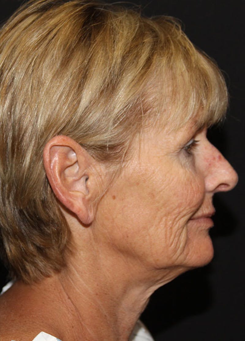 Facelift & Necklift Before & After Gallery - Patient 133023913 - Image 5