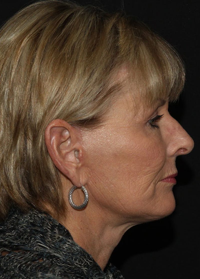 Facelift & Necklift Before & After Gallery - Patient 133023913 - Image 6