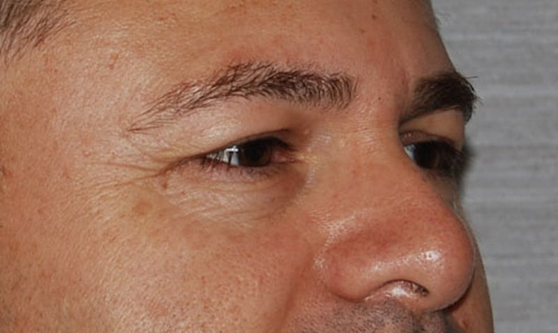 Eyelid Surgery Before & After Gallery - Patient 133023915 - Image 3