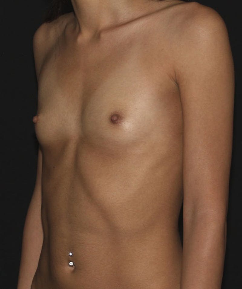 Breast Augmentation Before & After Gallery - Patient 133023916 - Image 7