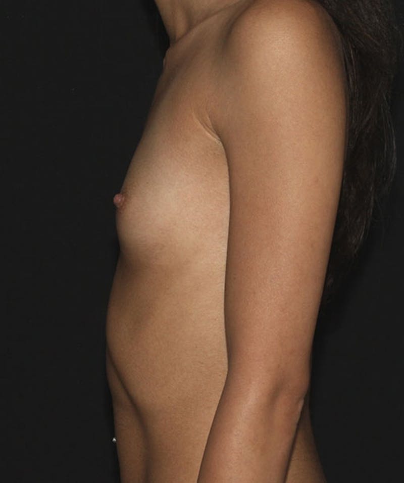 Breast Augmentation Before & After Gallery - Patient 133023916 - Image 9