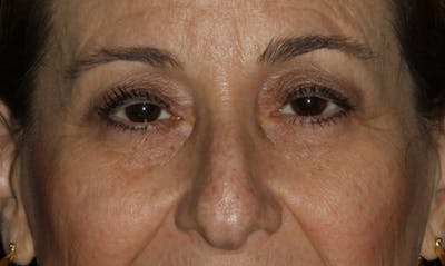 Eyelid Surgery Before & After Gallery - Patient 133023919 - Image 1