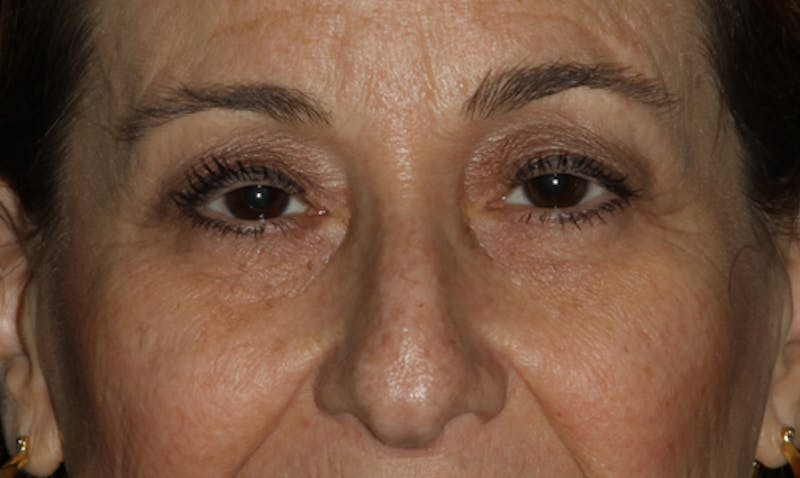Eyelid Surgery Before & After Gallery - Patient 133023919 - Image 1