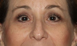 Eyelid Surgery Before & After Gallery - Patient 133023919 - Image 2
