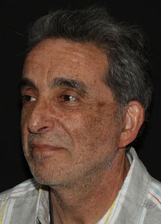 Facelift & Necklift Before & After Gallery - Patient 133023922 - Image 4