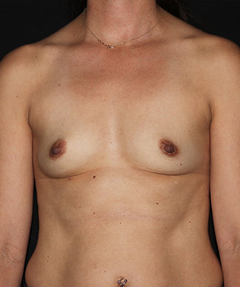 Breast Augmentation Before & After Gallery - Patient 133023929 - Image 1