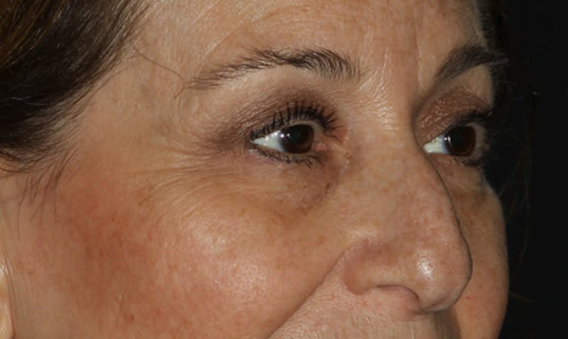 Eyelid Surgery Before & After Gallery - Patient 133023919 - Image 3