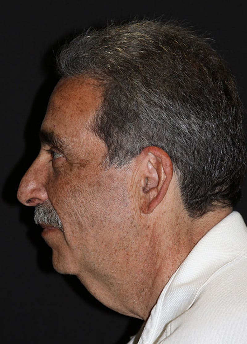 Facelift & Necklift Before & After Gallery - Patient 133023922 - Image 5