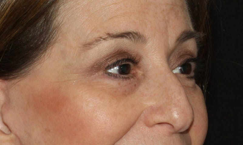 Eyelid Surgery Before & After Gallery - Patient 133023919 - Image 4
