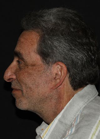 Facelift & Necklift Before & After Gallery - Patient 133023922 - Image 6