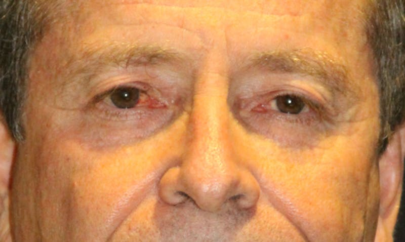 Eyelid Surgery Before & After Gallery - Patient 133023924 - Image 1