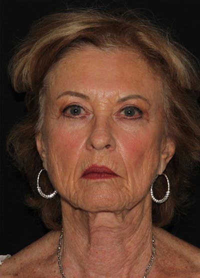 Facelift & Necklift Before & After Gallery - Patient 133023923 - Image 1