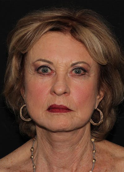 Facelift & Necklift Before & After Gallery - Patient 133023923 - Image 2