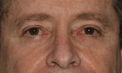 Eyelid Surgery Before & After Gallery - Patient 133023924 - Image 2