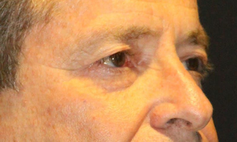 Eyelid Surgery Before & After Gallery - Patient 133023924 - Image 3