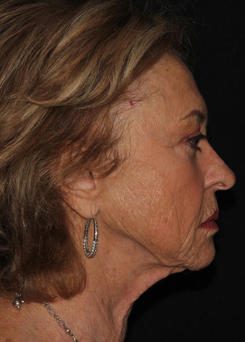 Facelift & Necklift Before & After Gallery - Patient 133023923 - Image 5