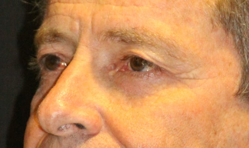 Eyelid Surgery Before & After Gallery - Patient 133023924 - Image 5