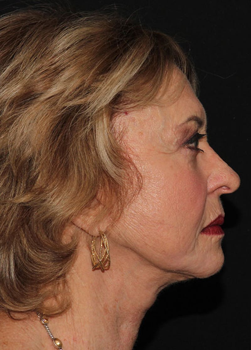 Facelift & Necklift Before & After Gallery - Patient 133023923 - Image 6