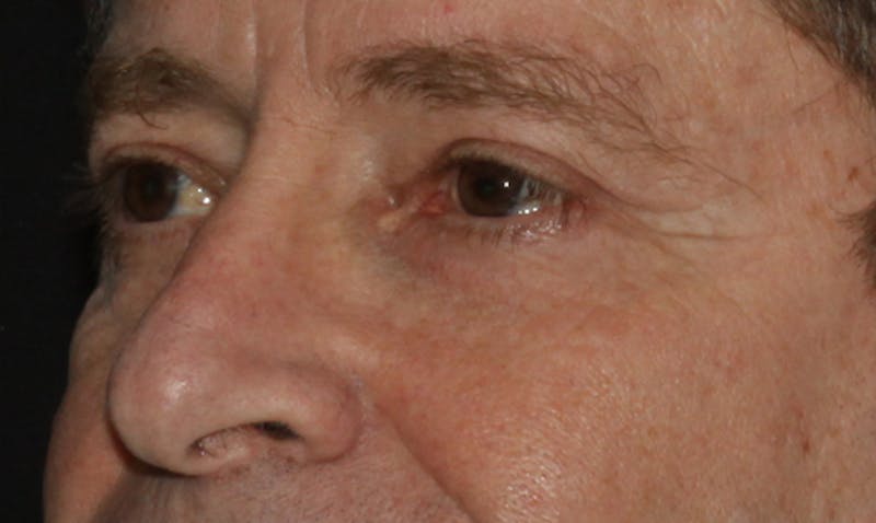 Eyelid Surgery Before & After Gallery - Patient 133023924 - Image 6