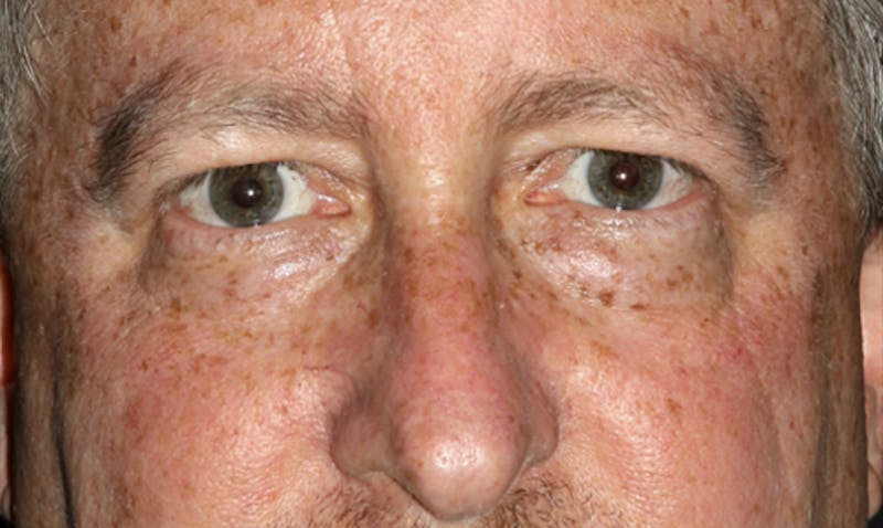 Eyelid Surgery Before & After Gallery - Patient 133023931 - Image 1