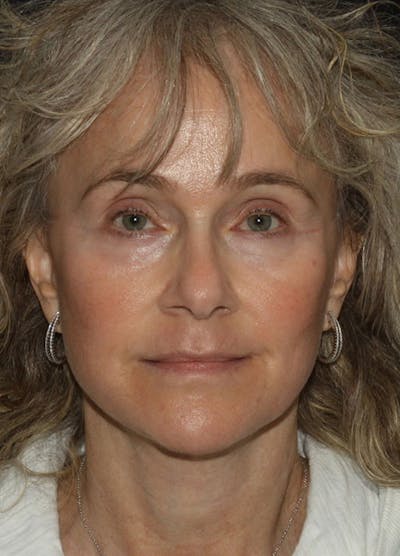 Facelift & Necklift Before & After Gallery - Patient 133023930 - Image 2