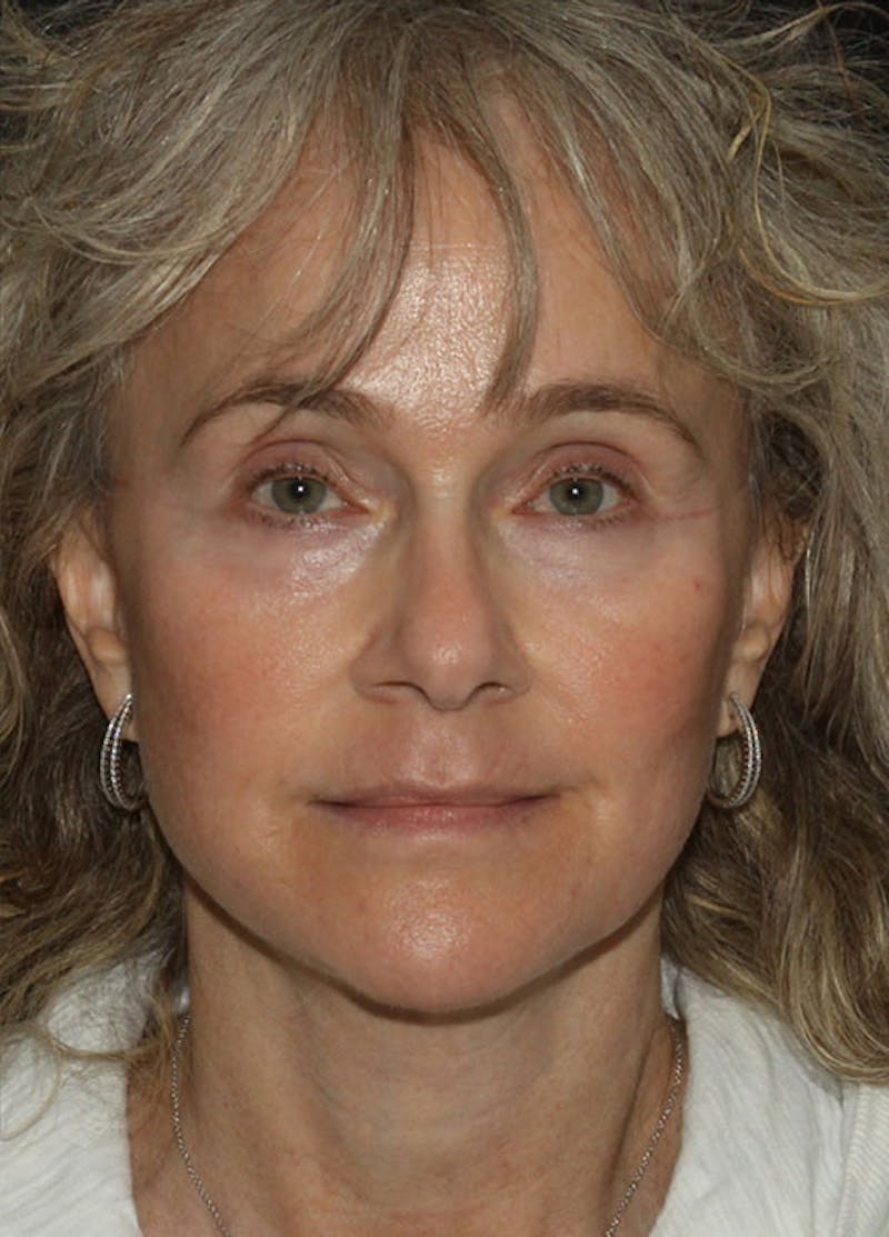 Facelift & Necklift Before & After Gallery - Patient 133023930 - Image 2