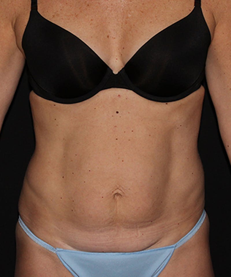 Tummy Tuck Before & After Gallery - Patient 133023942 - Image 1