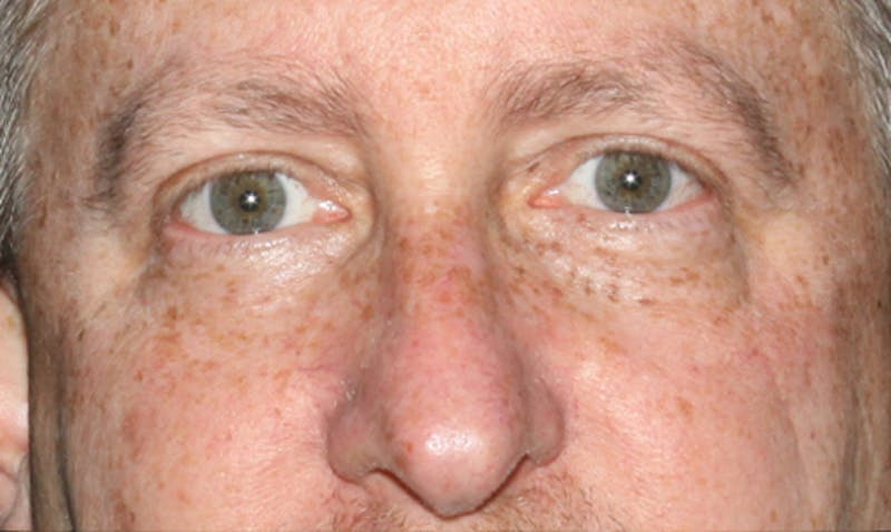 Eyelid Surgery Before & After Gallery - Patient 133023931 - Image 2