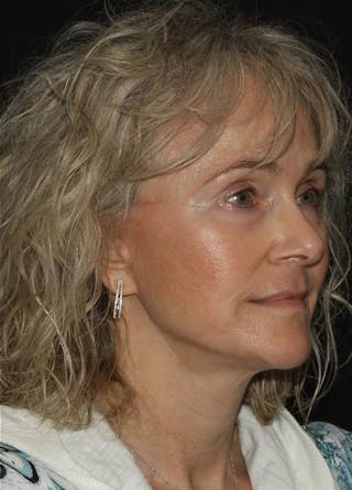 Facelift & Necklift Before & After Gallery - Patient 133023930 - Image 4