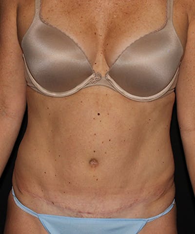 Tummy Tuck Before & After Gallery - Patient 133023942 - Image 2