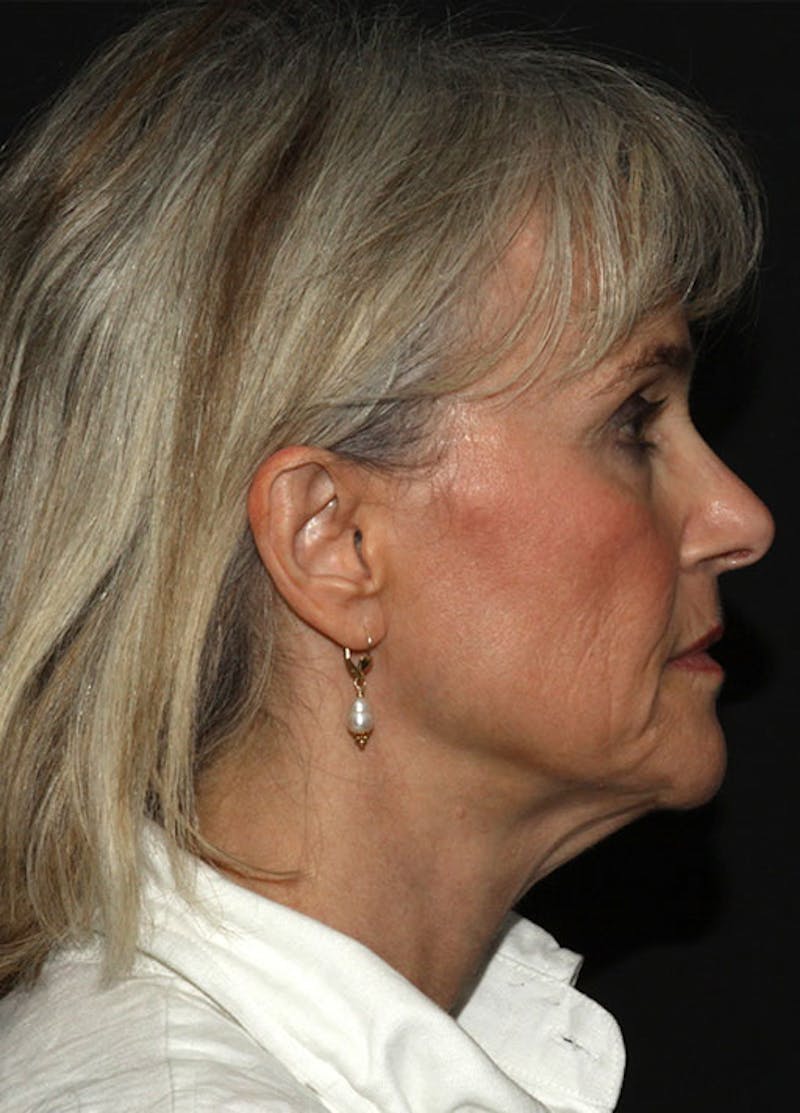Facelift & Necklift Before & After Gallery - Patient 133023930 - Image 5